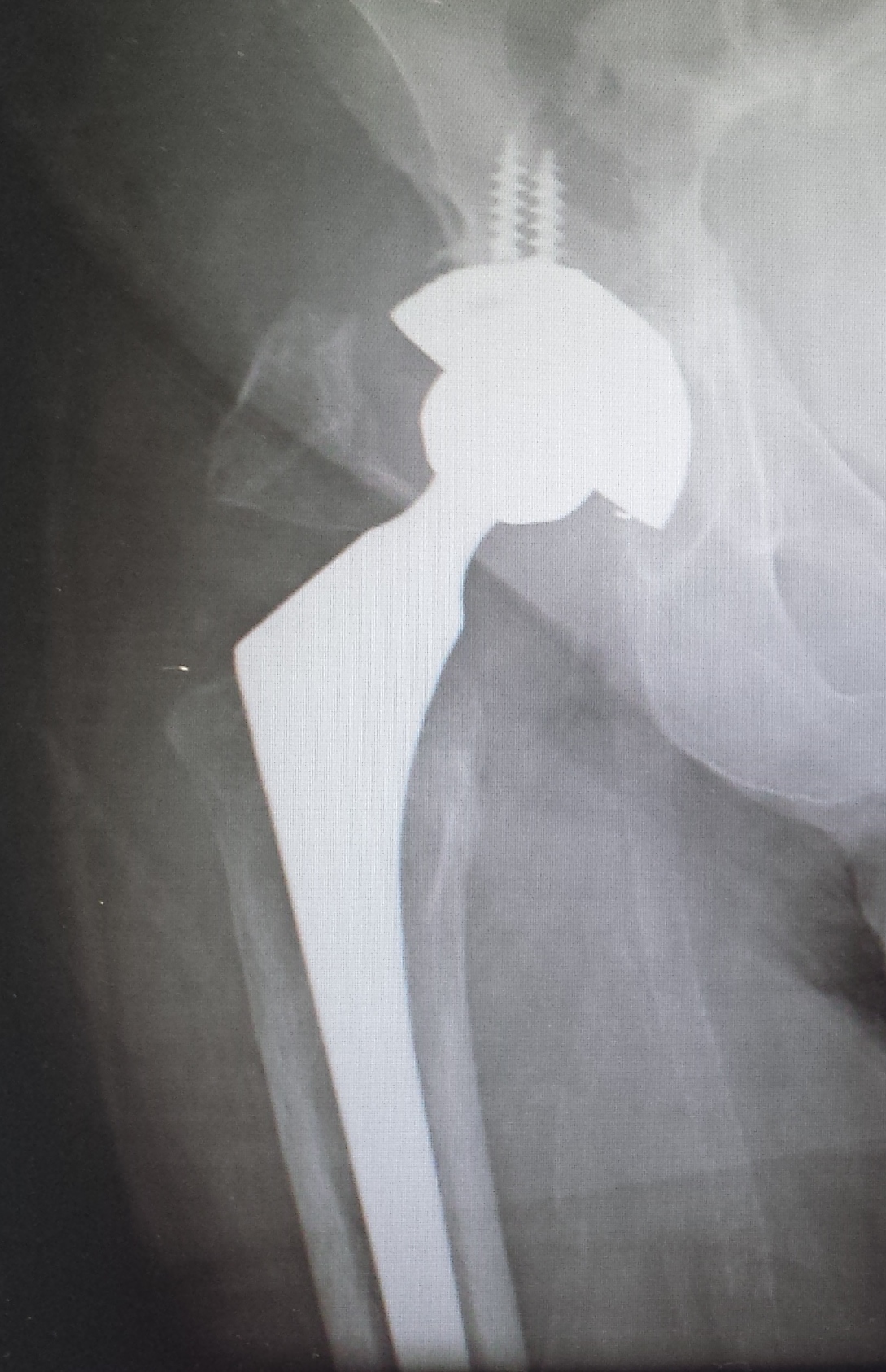Osteonics Secure-Fit HA (Implant 140708)